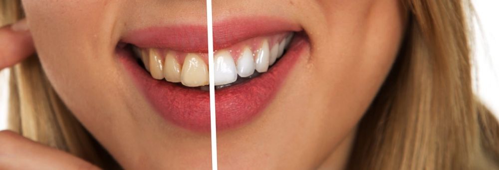 Tandpleje i Vallensbæk - Tips til at opretholde en sund mundhygiejne